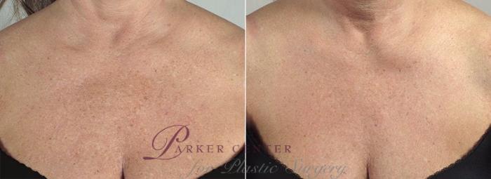 Halo™ Hybrid Fractional Case 321 Before & After View #1 | Paramus, New Jersey | Parker Center for Plastic Surgery