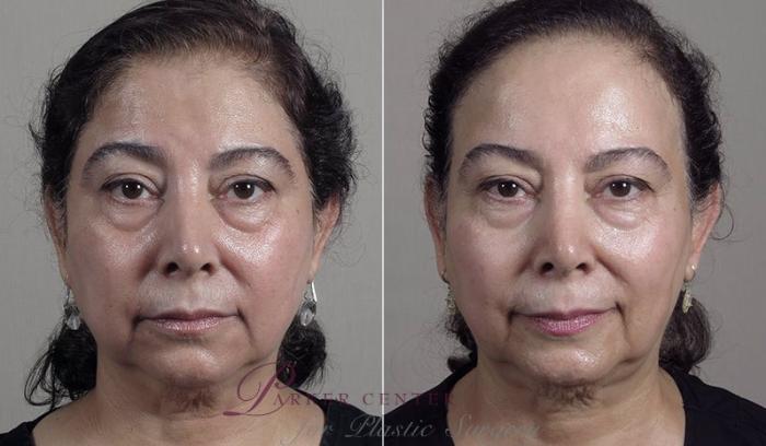 Halo™ Hybrid Fractional Case 344 Before & After View #1 | Paramus, New Jersey | Parker Center for Plastic Surgery