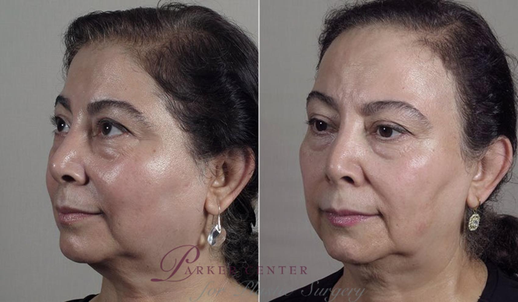 Halo™ Hybrid Fractional Case 344 Before & After View #2 | Paramus, New Jersey | Parker Center for Plastic Surgery