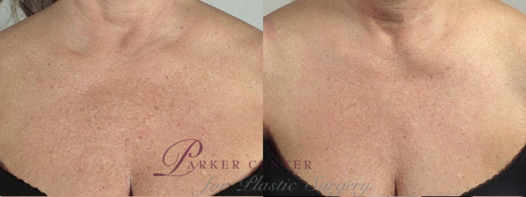 Halo™ Hybrid Fractional Case 961 Before & After View #5 | Paramus, New Jersey | Parker Center for Plastic Surgery