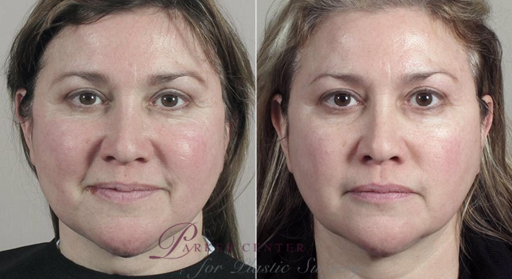 Halo™ Laser & Forever Young BBL™ Case 324 Before & After View #1 | Paramus, New Jersey | Parker Center for Plastic Surgery