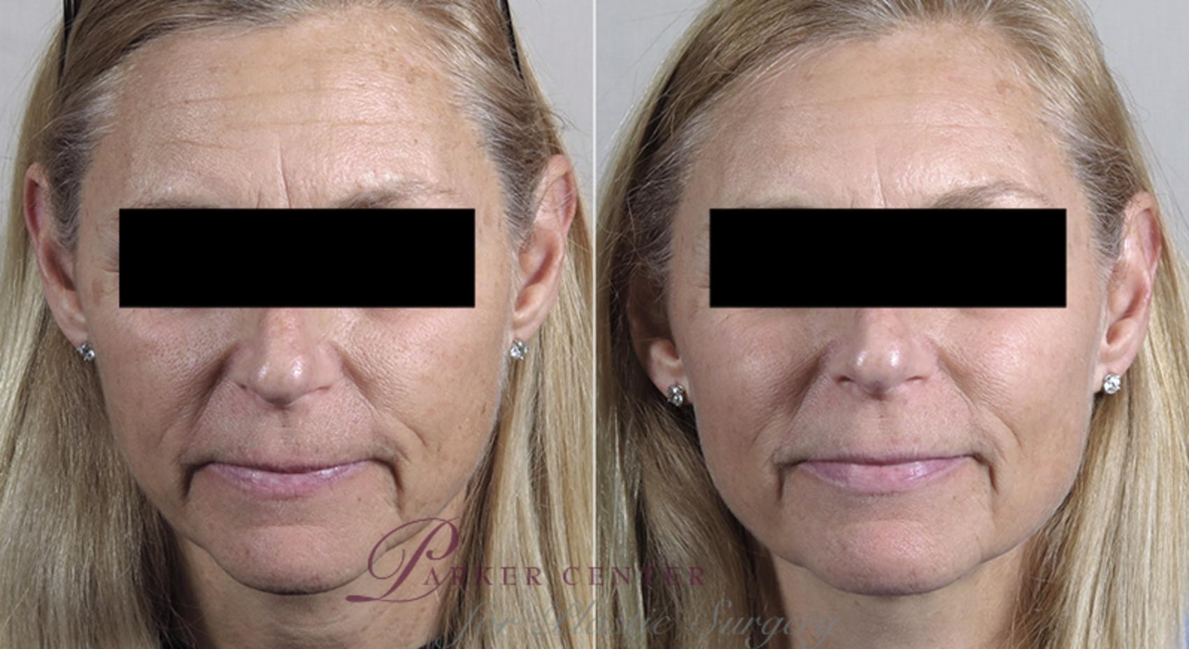 Halo™ Laser & Forever Young BBL™ Case 340 Before & After View #1 | Paramus, New Jersey | Parker Center for Plastic Surgery