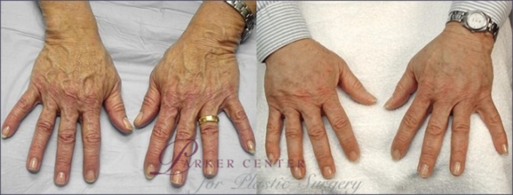 Hand Lift Case 938 Before & After View #5 | Paramus, NJ | Parker Center for Plastic Surgery