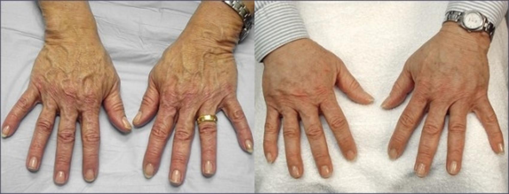 Hand Lift Case 938 Before & After View #5 | Paramus, New Jersey | Parker Center for Plastic Surgery