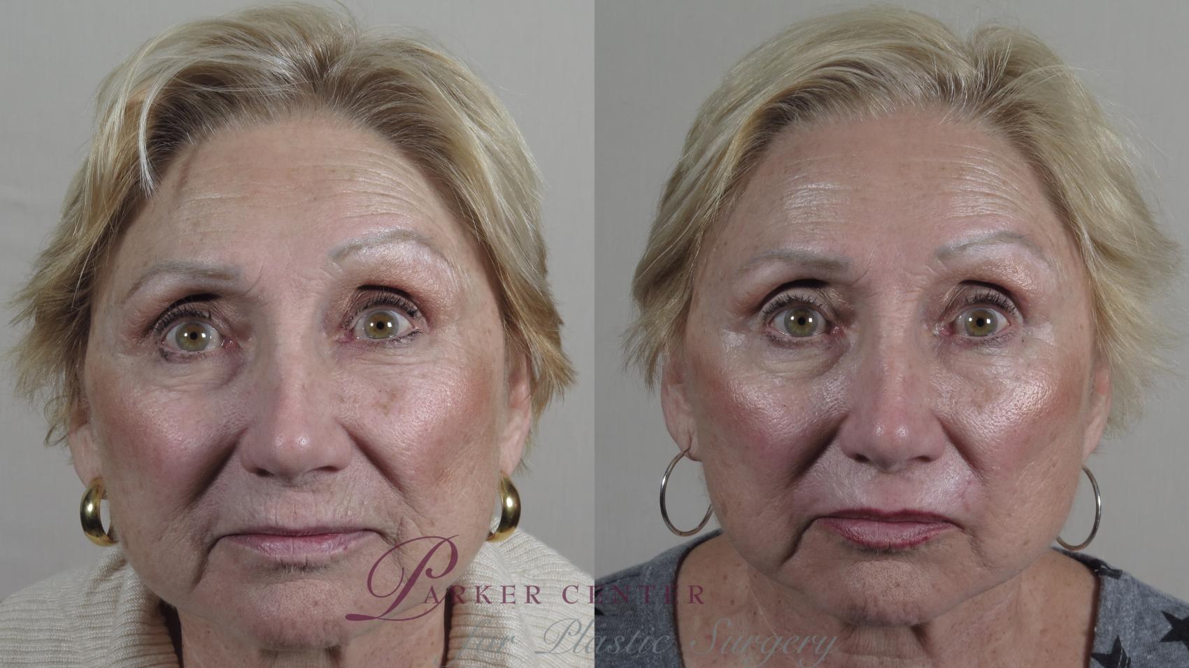 Lip Enhancement Case 1013 Before & After Front | Paramus, NJ | Parker Center for Plastic Surgery