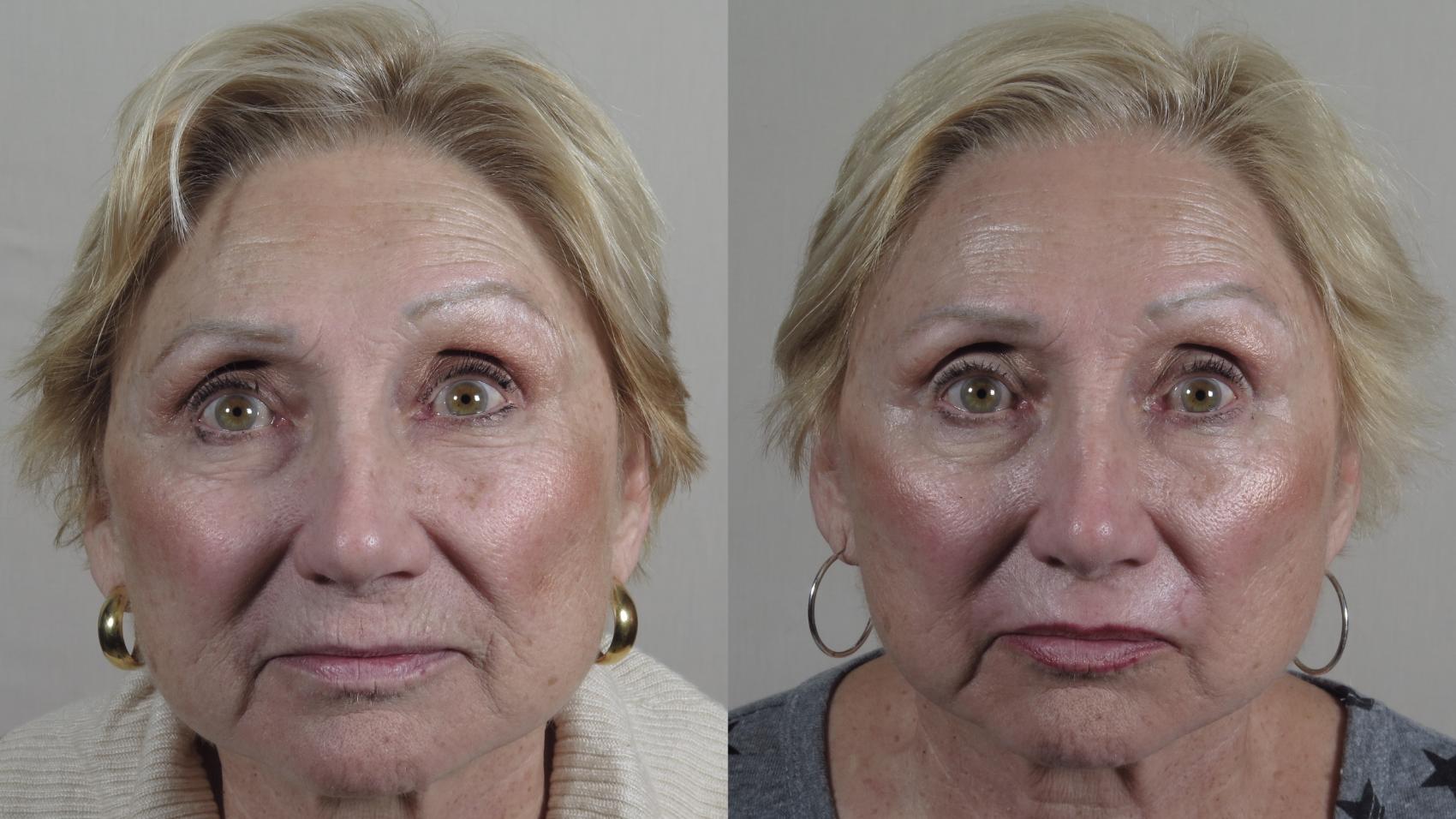 Lip Enhancement Case 1013 Before & After Front | Paramus, NJ | Parker Center for Plastic Surgery