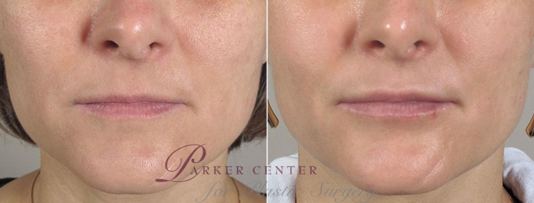 Lip Enhancement Case 257 Before & After View #1 | Paramus, NJ | Parker Center for Plastic Surgery