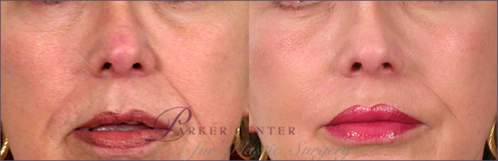 Lip Enhancement Case 258 Before & After View #1 | Paramus, NJ | Parker Center for Plastic Surgery