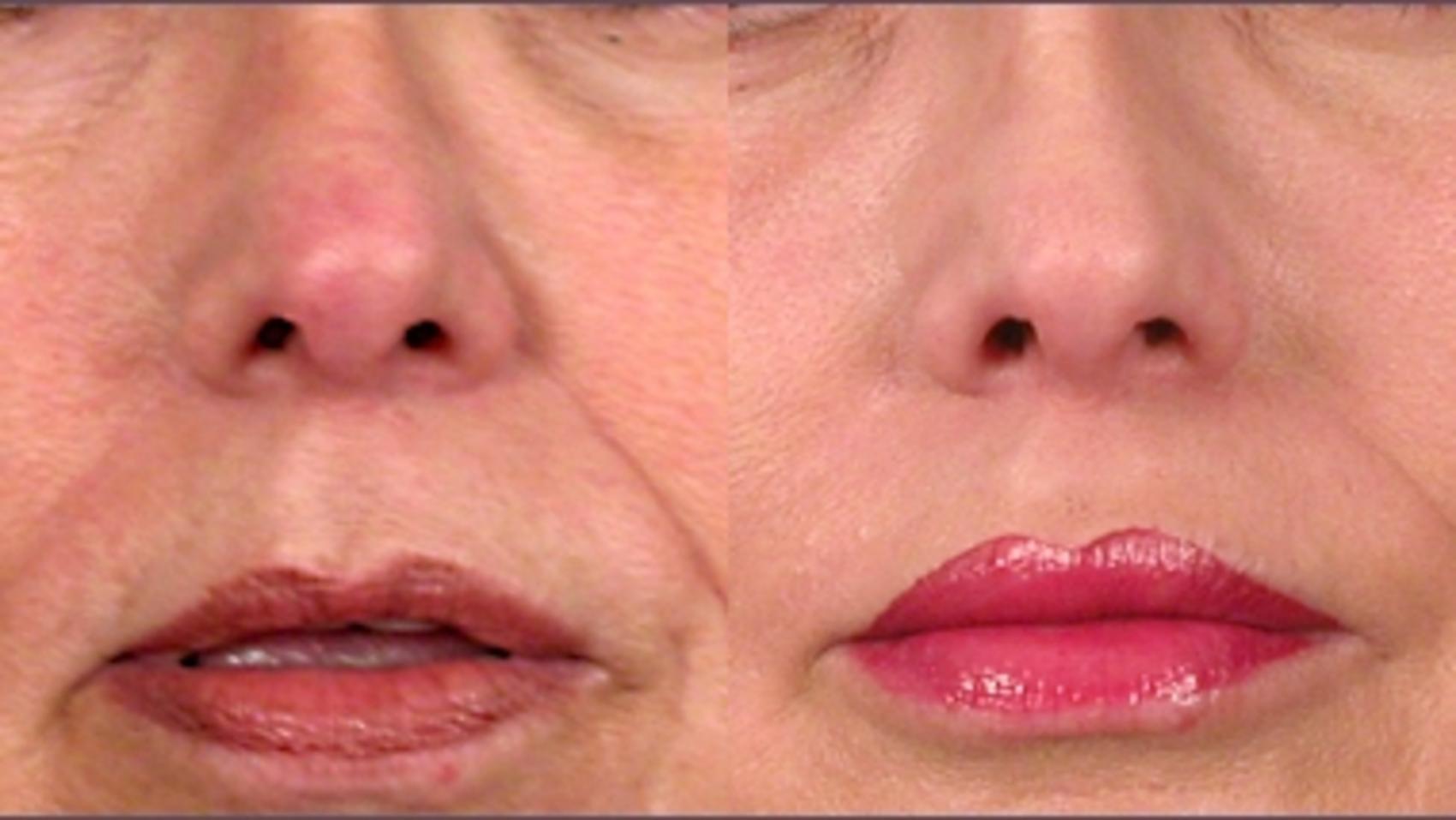 Lip Enhancement Case 258 Before & After View #1 | Paramus, New Jersey | Parker Center for Plastic Surgery