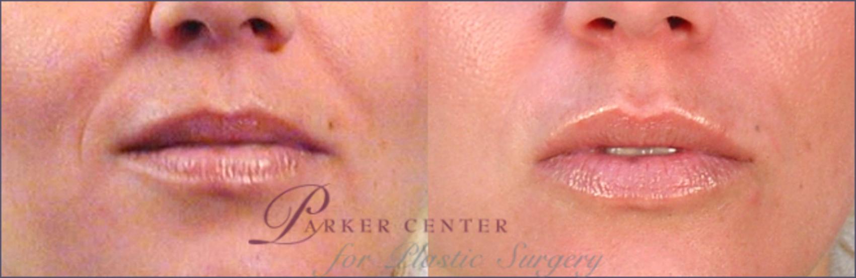 Lip Enhancement Case 259 Before & After View #1 | Paramus, NJ | Parker Center for Plastic Surgery