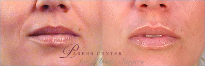 Lip Enhancement Case 259 Before & After View #1 | Paramus, NJ | Parker Center for Plastic Surgery