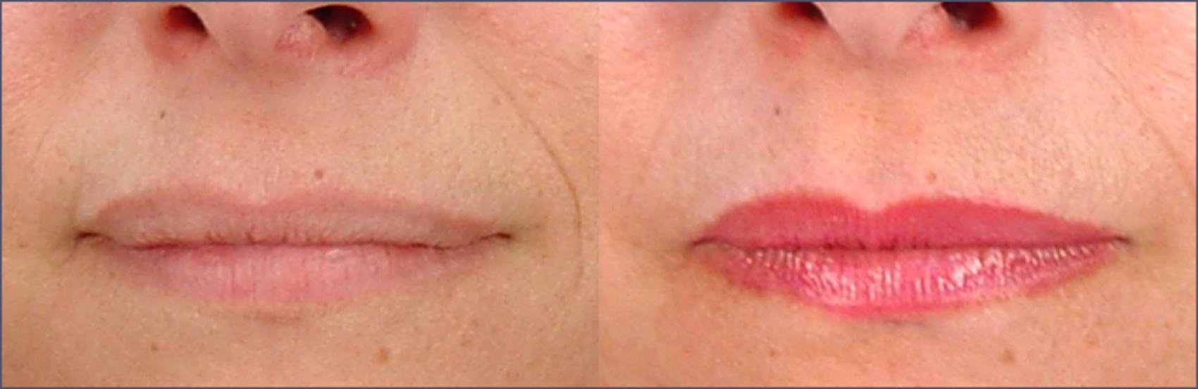 Lip Enhancement Case 260 Before & After View #1 | Paramus, New Jersey | Parker Center for Plastic Surgery