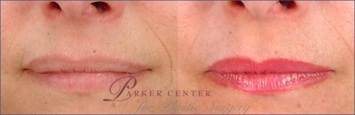 Lip Enhancement Case 260 Before & After View #1 | Paramus, NJ | Parker Center for Plastic Surgery