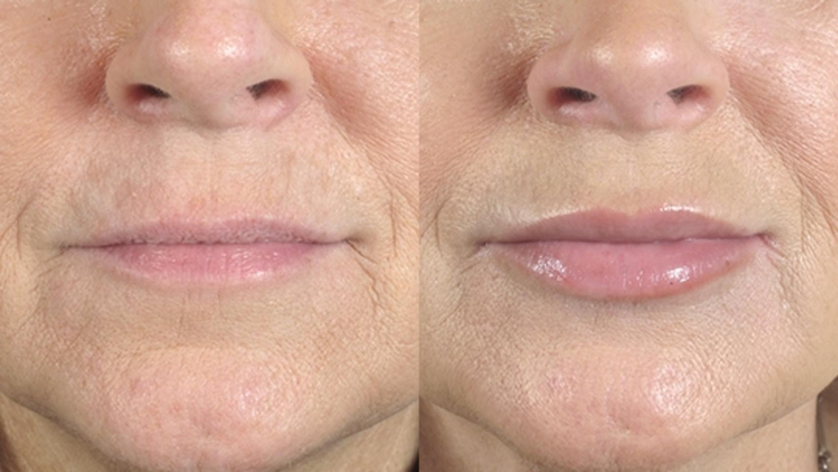 Lip Enhancement Case 261 Before & After View #1 | Paramus, New Jersey | Parker Center for Plastic Surgery