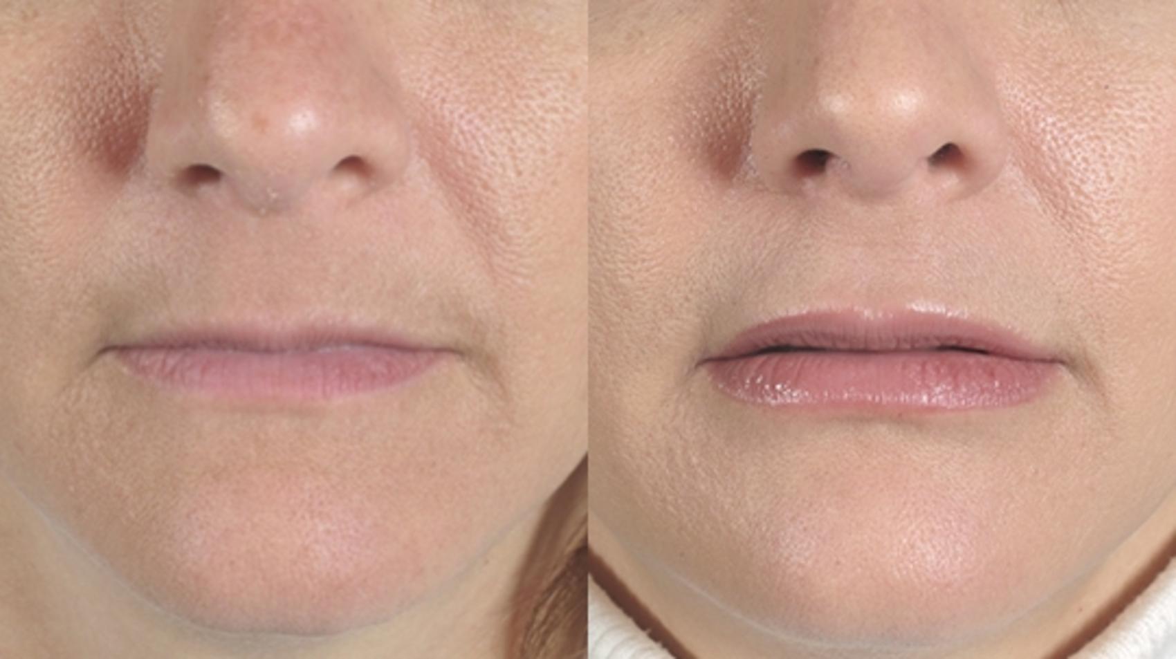 Lip Enhancement Case 262 Before & After View #1 | Paramus, New Jersey | Parker Center for Plastic Surgery