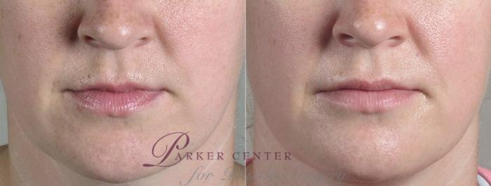 Lip Enhancement Case 264 Before & After View #1 | Paramus, NJ | Parker Center for Plastic Surgery
