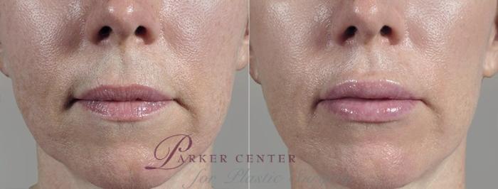 Lip Enhancement Case 265 Before & After View #1 | Paramus, NJ | Parker Center for Plastic Surgery