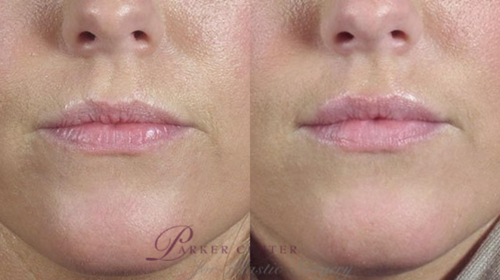 Dermal Fillers Case 290 Before & After View #1 | Paramus, New Jersey | Parker Center for Plastic Surgery