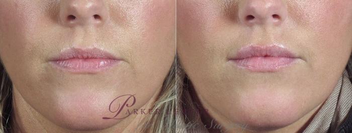 Lip Enhancement Case 290 Before & After View #1 | Paramus, New Jersey | Parker Center for Plastic Surgery