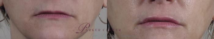Lip Enhancement Case 963 Before & After View #5 | Paramus, NJ | Parker Center for Plastic Surgery