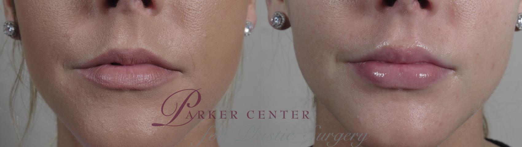 Lip Enhancement Case 979 Before & After Front | Paramus, NJ | Parker Center for Plastic Surgery