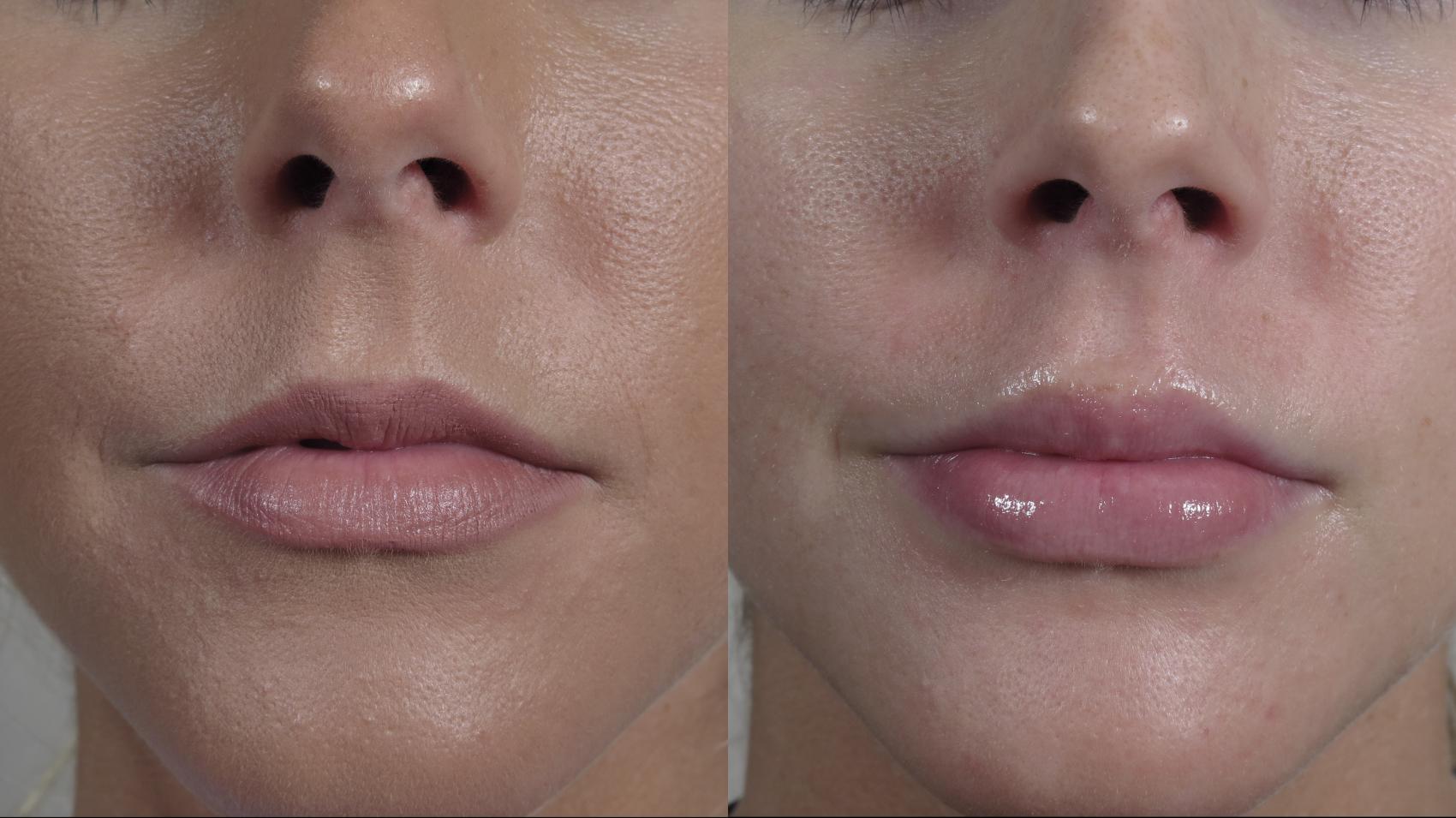 Lip Enhancement Case 979 Before & After Front | Paramus, NJ | Parker Center for Plastic Surgery