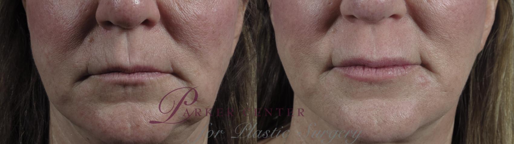 Lip Enhancement Case 981 Before & After Front | Paramus, NJ | Parker Center for Plastic Surgery