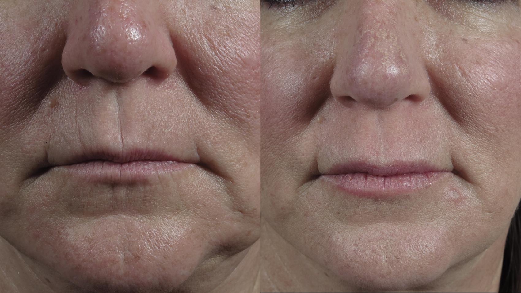 Lip Enhancement Case 981 Before & After Front | Paramus, NJ | Parker Center for Plastic Surgery