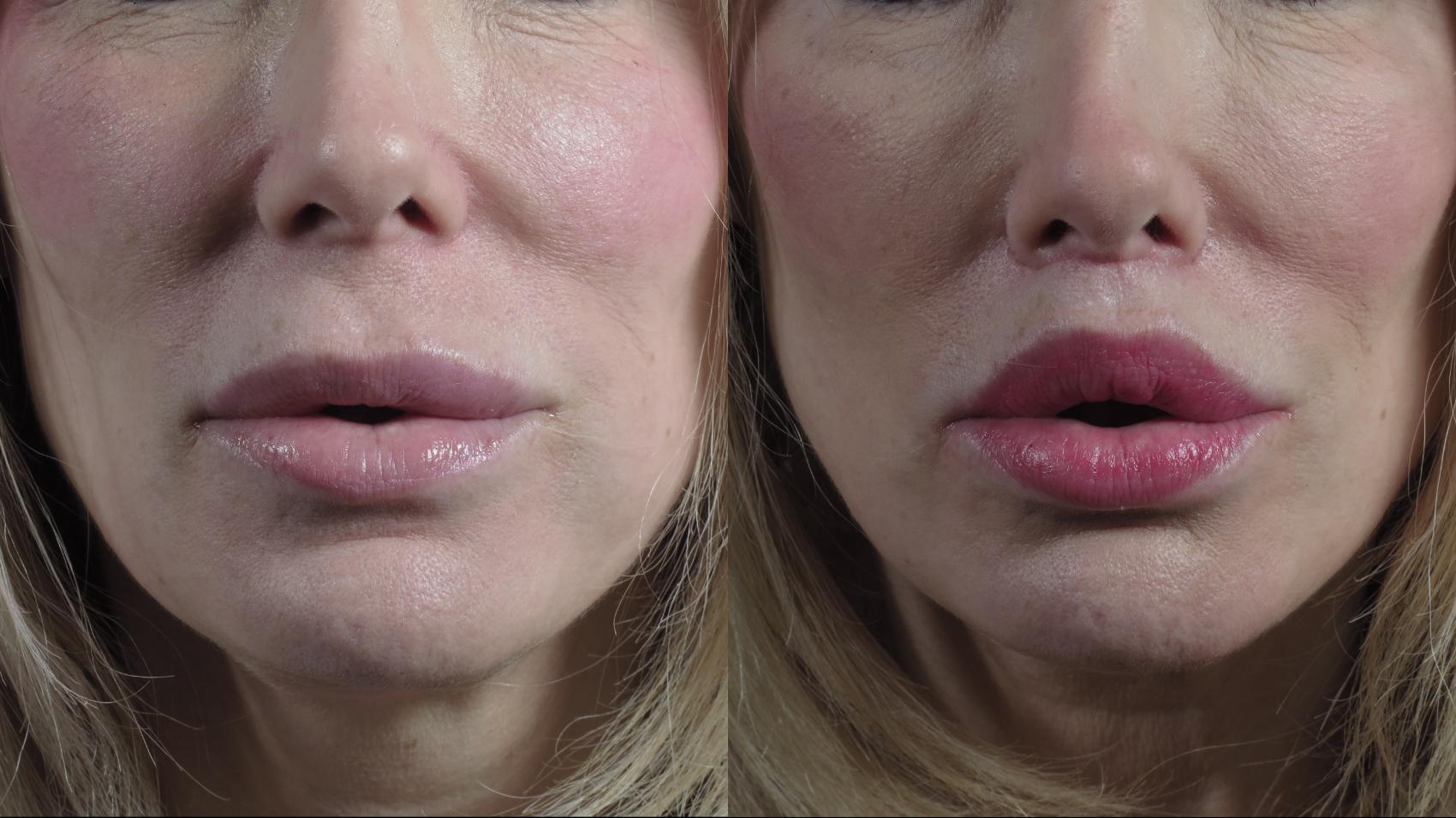 Lip Lift Case 1230 Before & After Front | Paramus, NJ | Parker Center for Plastic Surgery