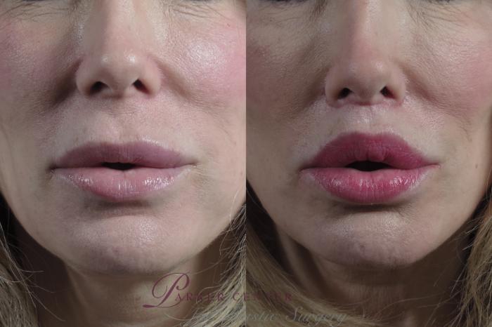Lip Lift Case 1230 Before & After Front | Paramus, NJ | Parker Center for Plastic Surgery