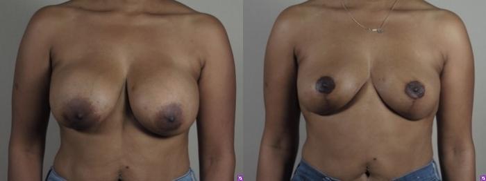 Lip Lift Case 1249 Before & After Front | Paramus, New Jersey | Parker Center for Plastic Surgery