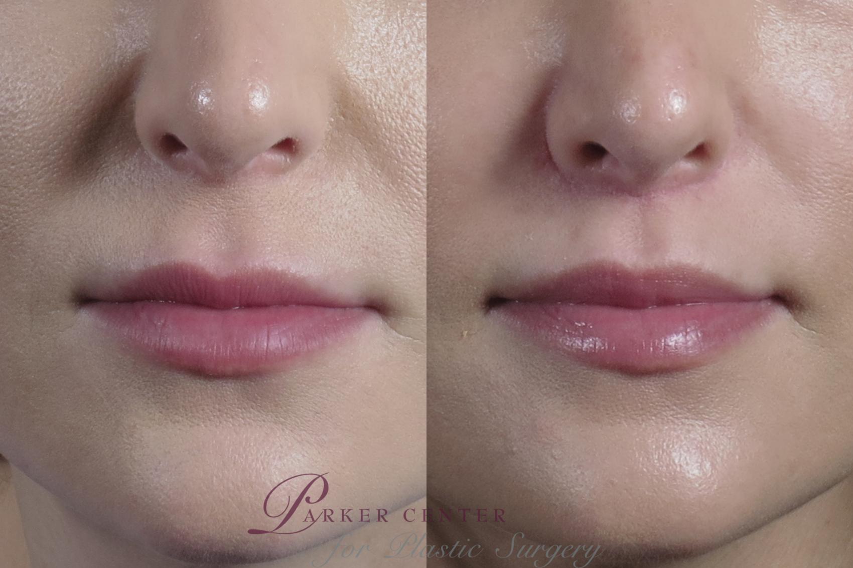 Lip Lift Case 1290 Before & After Front | Paramus, NJ | Parker Center for Plastic Surgery