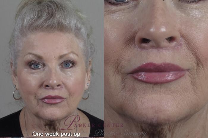 Lip Lift Case 1355 Before & After 1 week  | Paramus, New Jersey | Parker Center for Plastic Surgery