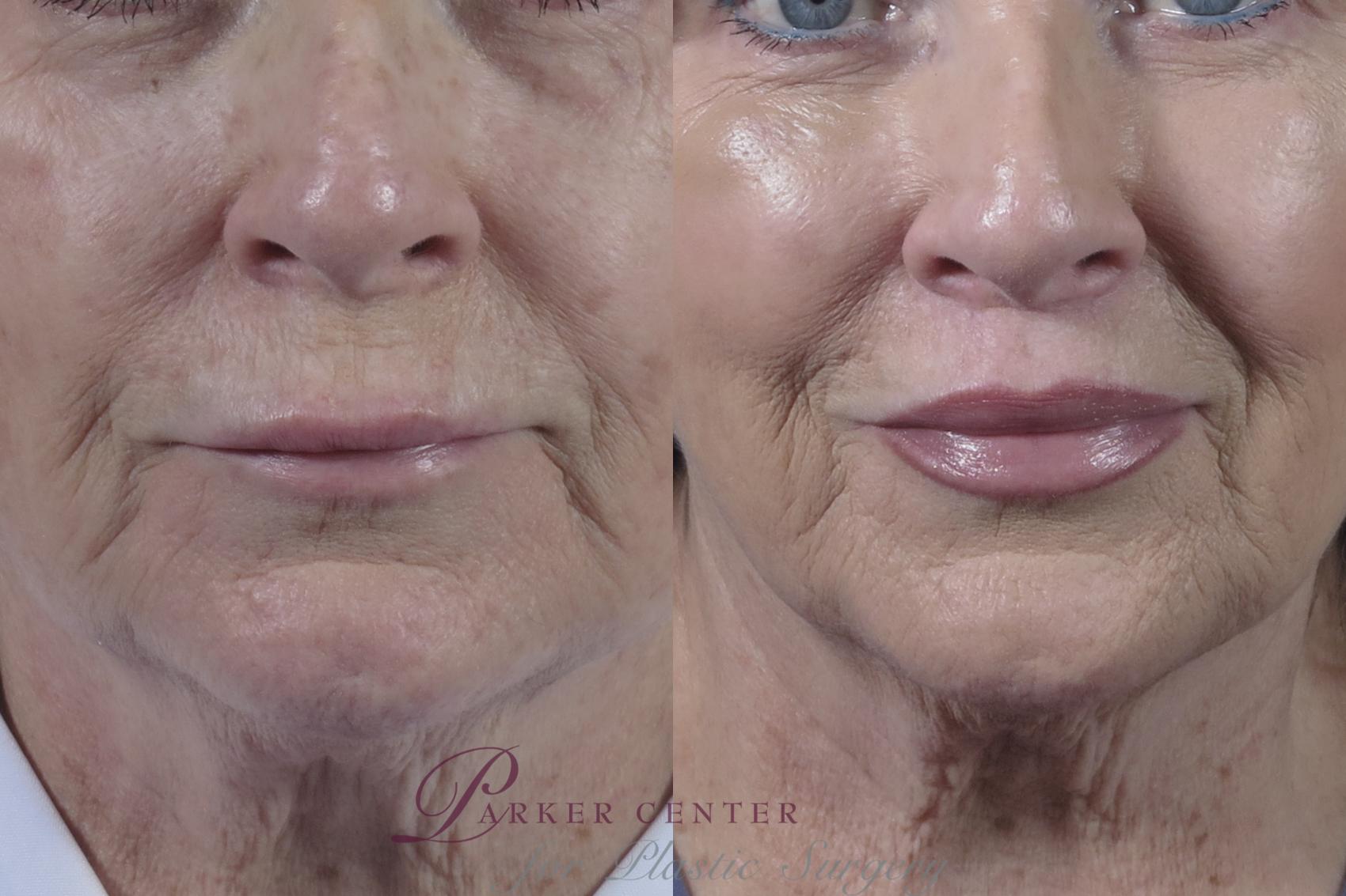 Lip Lift Case 1355 Before & After Front | Paramus, New Jersey | Parker Center for Plastic Surgery