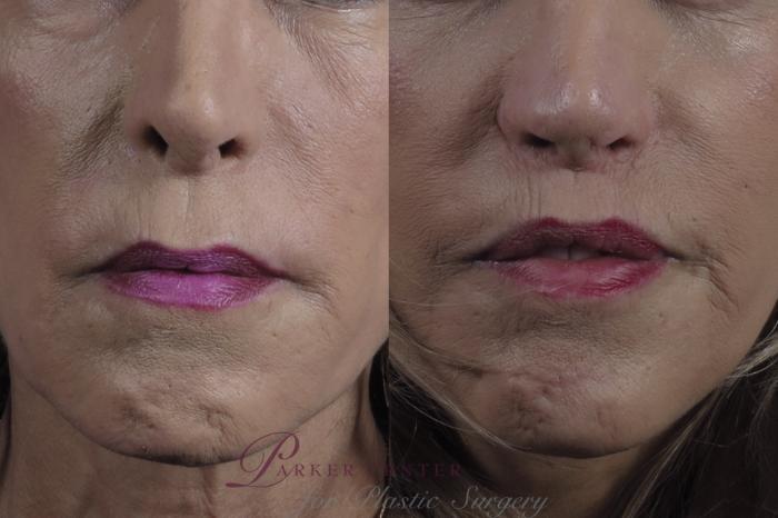 Lip Lift Case 1376 Before & After Front | Paramus, NJ | Parker Center for Plastic Surgery