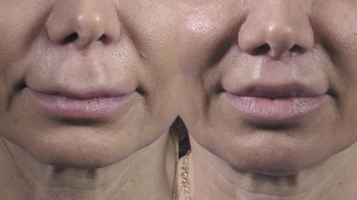 Lip Lift Case 1392 Before & After Front | Paramus, New Jersey | Parker Center for Plastic Surgery