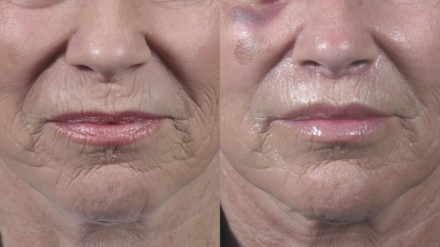 Lip Lift Case 1407 Before & After Front | Paramus, New Jersey | Parker Center for Plastic Surgery