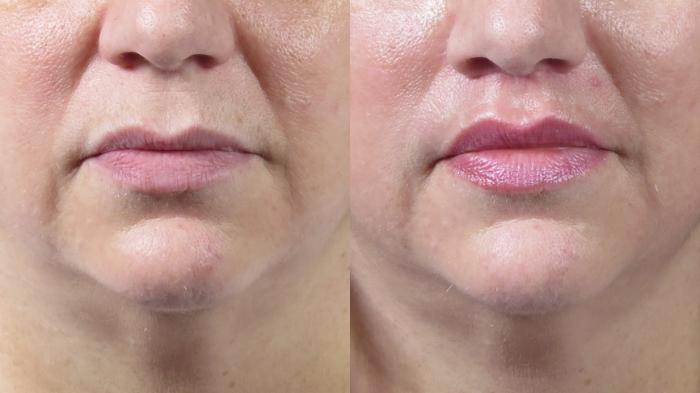 Lip Lift Case 1537 Before & After Left Side | Paramus, New Jersey | Parker Center for Plastic Surgery