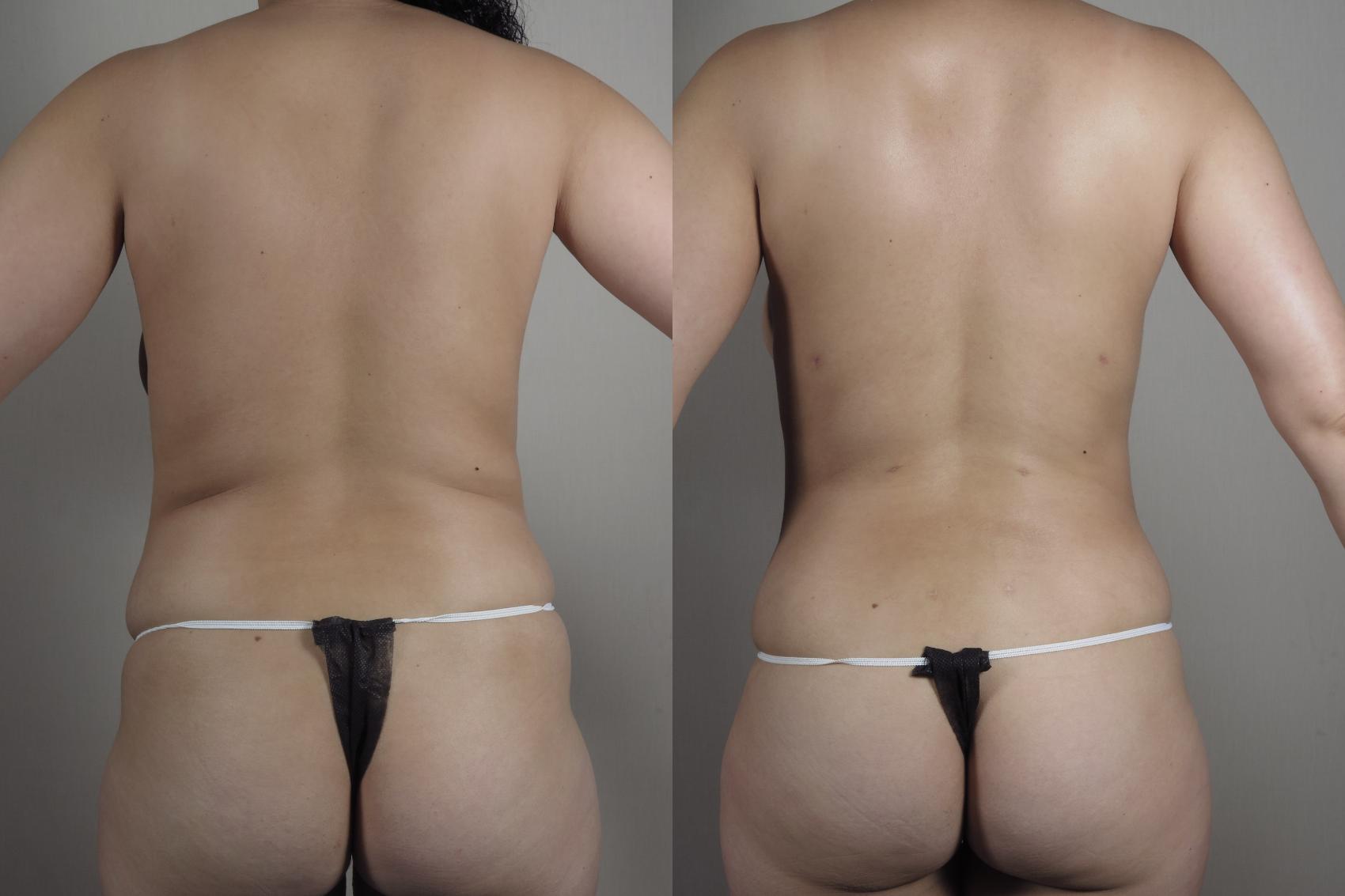 Liposuction Case 1030 Before & After Back | Paramus, New Jersey | Parker Center for Plastic Surgery