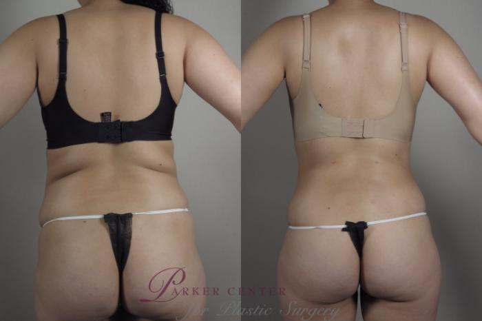 Liposuction Case 1030 Before & After Back w bra | Paramus, NJ | Parker Center for Plastic Surgery