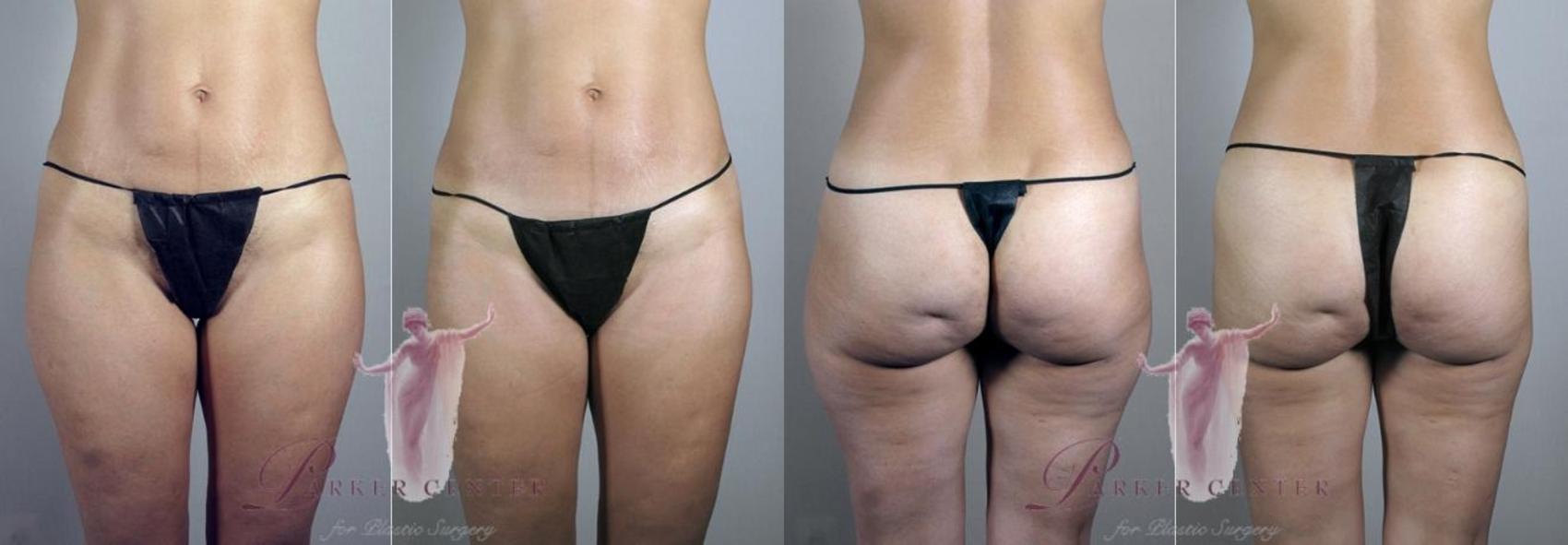 Liposuction Case 1102 Before & After Front | Paramus, NJ | Parker Center for Plastic Surgery