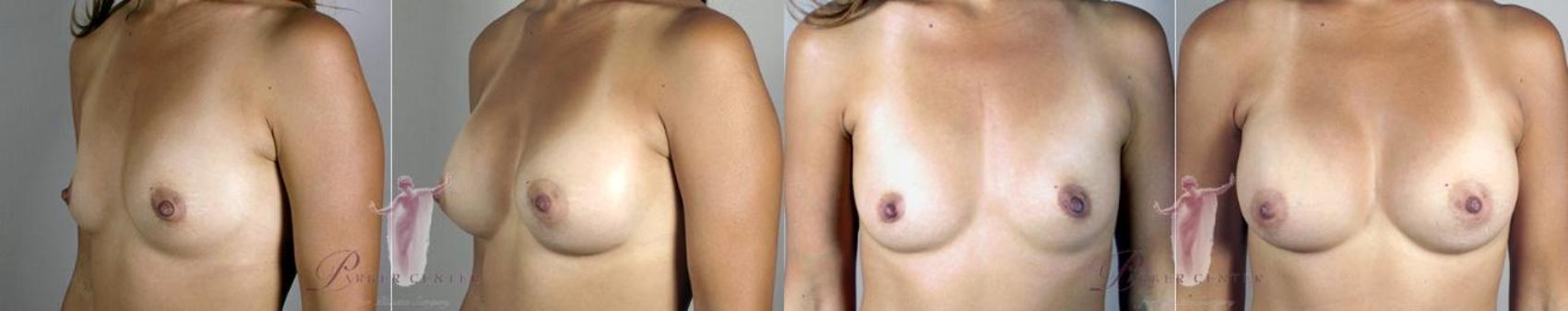 Liposuction Case 1102 Before & After Left Side | Paramus, NJ | Parker Center for Plastic Surgery