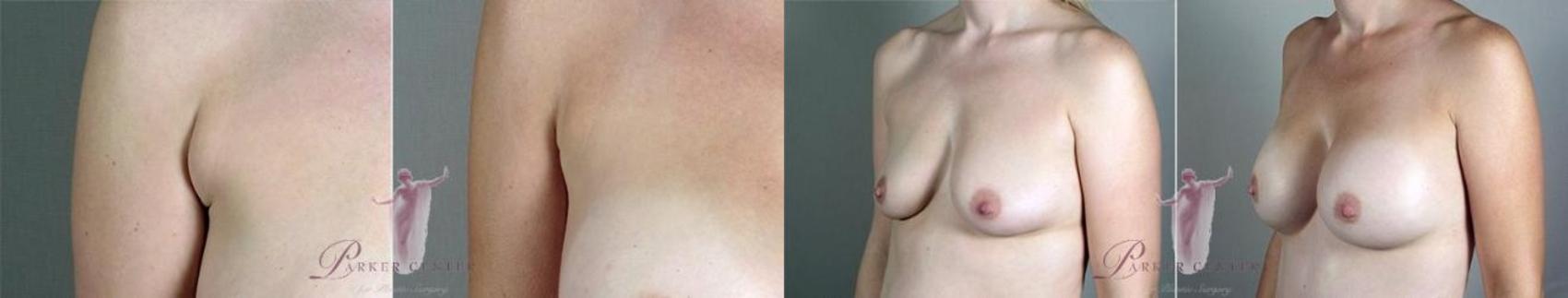 Breast Augmentation Case 1103 Before & After Front | Paramus, NJ | Parker Center for Plastic Surgery