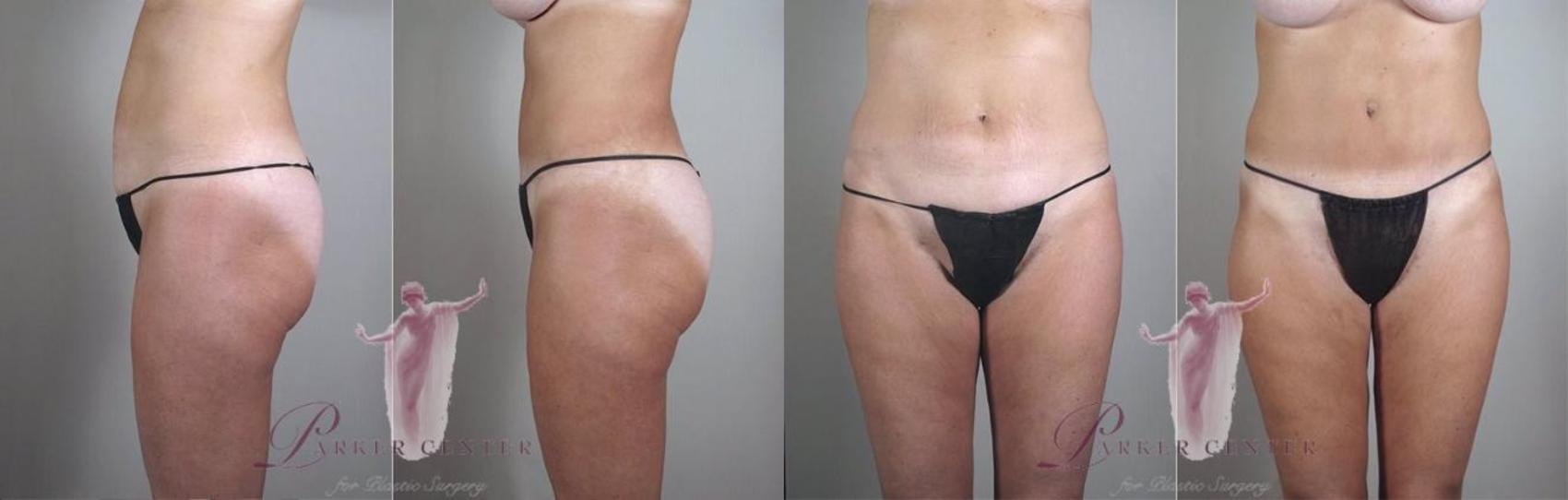 Liposuction Case 1117 Before & After Front | Paramus, NJ | Parker Center for Plastic Surgery