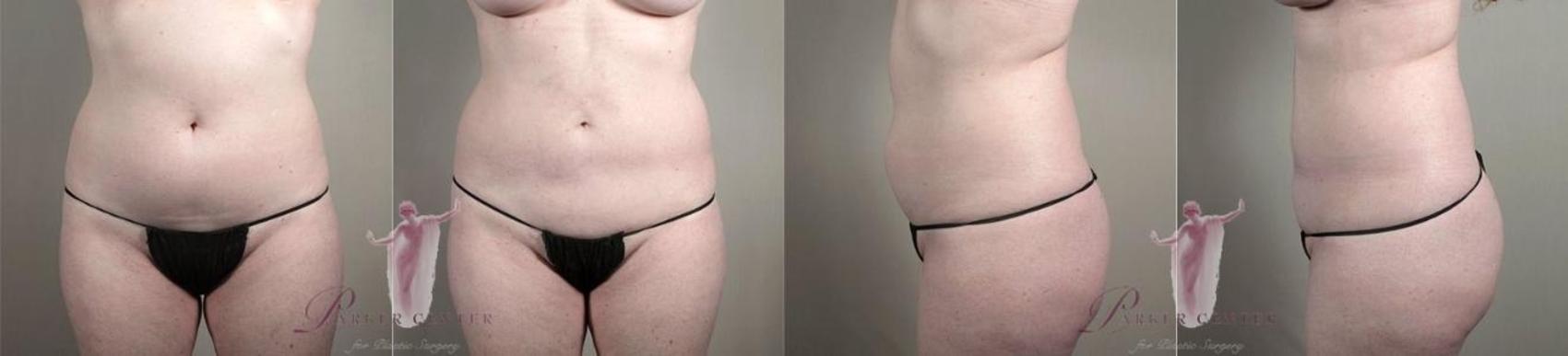 Liposuction Case 1123 Before & After Front | Paramus, NJ | Parker Center for Plastic Surgery