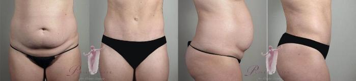 Liposuction Case 1126 Before & After Front | Paramus, NJ | Parker Center for Plastic Surgery