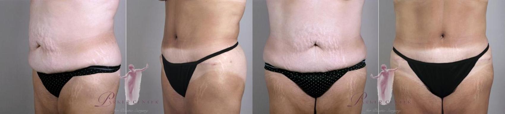 Liposuction Case 1128 Before & After Front | Paramus, NJ | Parker Center for Plastic Surgery