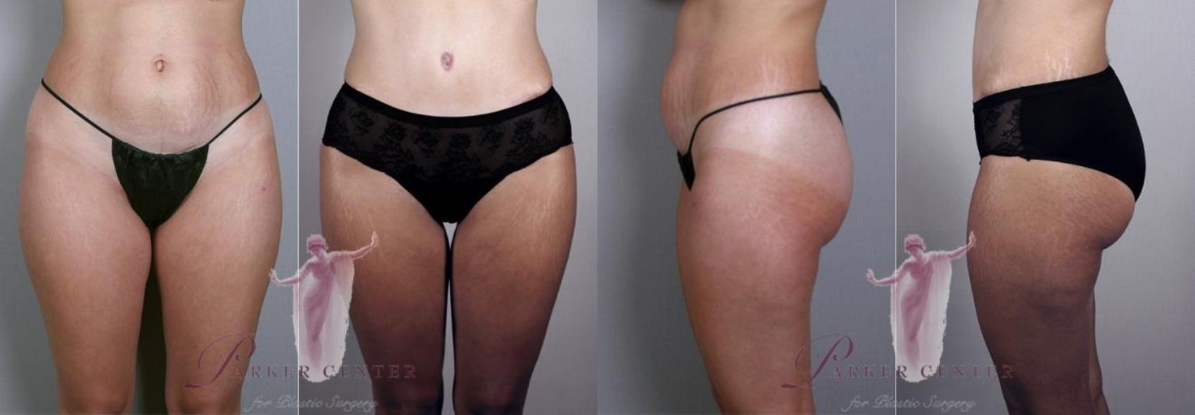 Liposuction Case 1129 Before & After Front | Paramus, NJ | Parker Center for Plastic Surgery