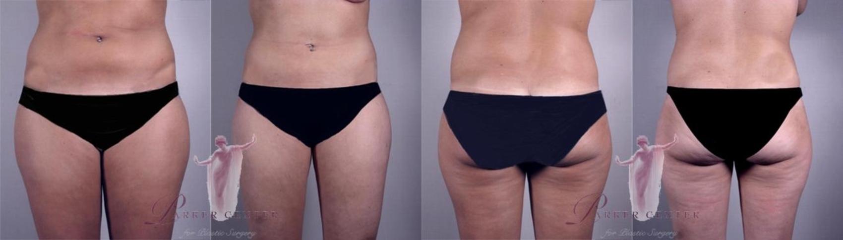 Liposuction Case 1155 Before & After Front | Paramus, NJ | Parker Center for Plastic Surgery