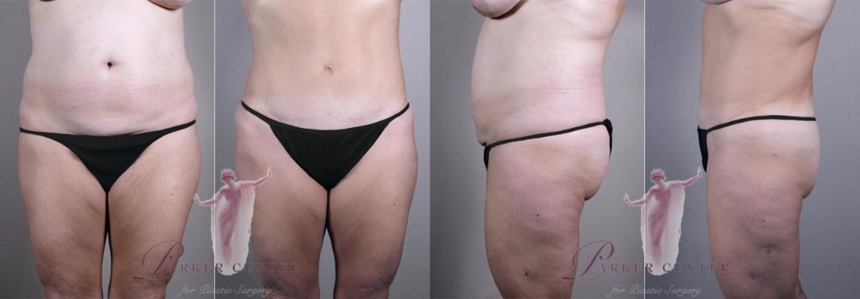 Liposuction Case 1163 Before & After Front | Paramus, NJ | Parker Center for Plastic Surgery